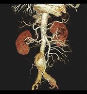 Image result for CT Angiogram Abdomen