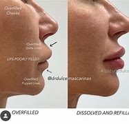 Image result for Bad Lip Fillers