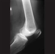 Image result for Lateral Knee Radiograph