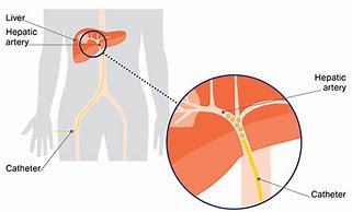 Image result for Tace Ablation