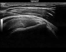 Image result for Sasd Bursitis