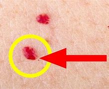 Image result for Dark Red Spots On Skin