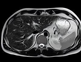 Image result for IRM Abdominale