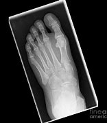 Image result for Foot Bones X-ray