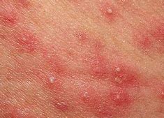 Image result for Skin Rash with Pustules