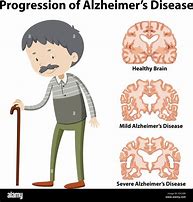 Image result for ALZ Disease