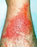 Image result for Poison Ivy Rash Cream