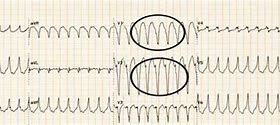 Image result for Right Ventricular Outflow Tract