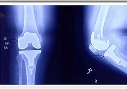 Image result for Ochronosis Knee