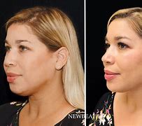 Image result for CoolSculpting Chin Before and After