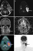 Image result for Hodgkin Lymphoma PET/CT