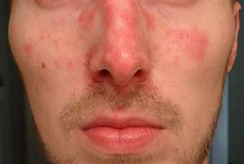 Image result for Sudden Rash On Face