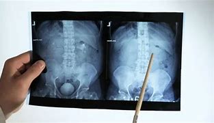 Image result for Kidney On X-ray