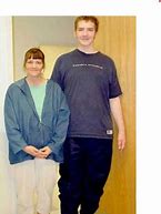 Image result for Gigantism Face