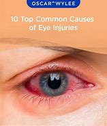 Image result for Eye Accident Kidd