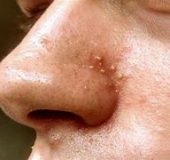 Image result for Pustules On Nose