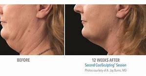 Image result for CoolSculpting Chin Before and After