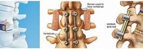 Image result for Lumbosacral Fusion