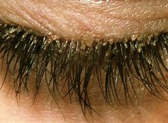 Image result for Eyelaash Mites