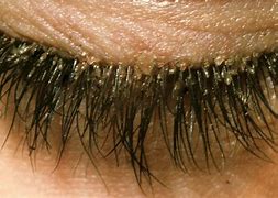 Image result for Mites On Lashes