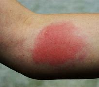 Image result for Spider Rash