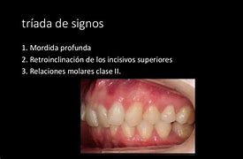 Image result for Tipos De Maloclusion