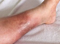 Image result for Thrombotic Veins