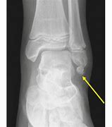 Image result for Area Distal to Lateral Malleolus