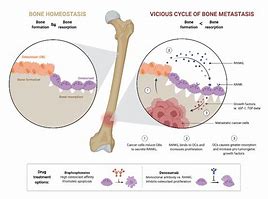 Image result for DDR and Bone Metastasis