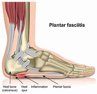 Image result for Treatment for Plantar Fasciitis