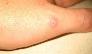 Image result for Spider Bite Pimple