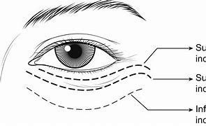 Image result for Orbital Floor Surgery in the Or