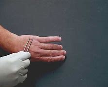 Image result for Filiform Wart On Finger