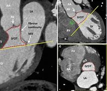 Image result for Anatomical Site of Left Ventricular Outflow Tract