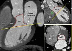 Image result for Right Ventricular Outflow Tract