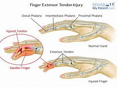 Image result for Extensor Tendons Dorsal Hand