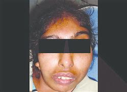 Image result for Malar Hypoplasia