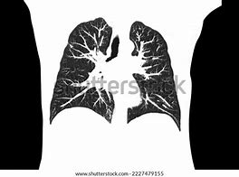 Image result for Coronal Lung CT