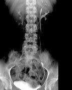 Image result for Long Tunnel Ureter