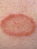 Image result for Small Red Circular Rash On Skin