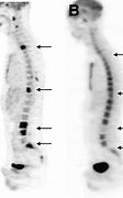 Image result for Pet Scan Lymphoma Example