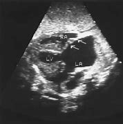 Image result for Right Atrial Appendage Fetal Echo