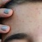 Image result for Acnes Clear Patch