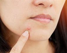 Image result for People with Pimples