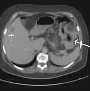 Image result for cáncer de Colón tac. Size: 184 x 179. Source: cirujanomonterrey.com