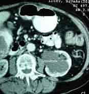 Image result for cáncer de Colón tac. Size: 174 x 185. Source: quevihoy.blogspot.com