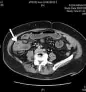 Image result for cáncer de Colón tac. Size: 173 x 185. Source: www.cesurformacion.com