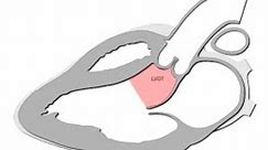 Abolitions or Treatments for Left ventricular Outflow tract Obstruction