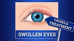 Swollen Eyelid: Causes & Treatment