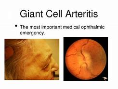 Image result for Temporal Artery Biopsy Technique